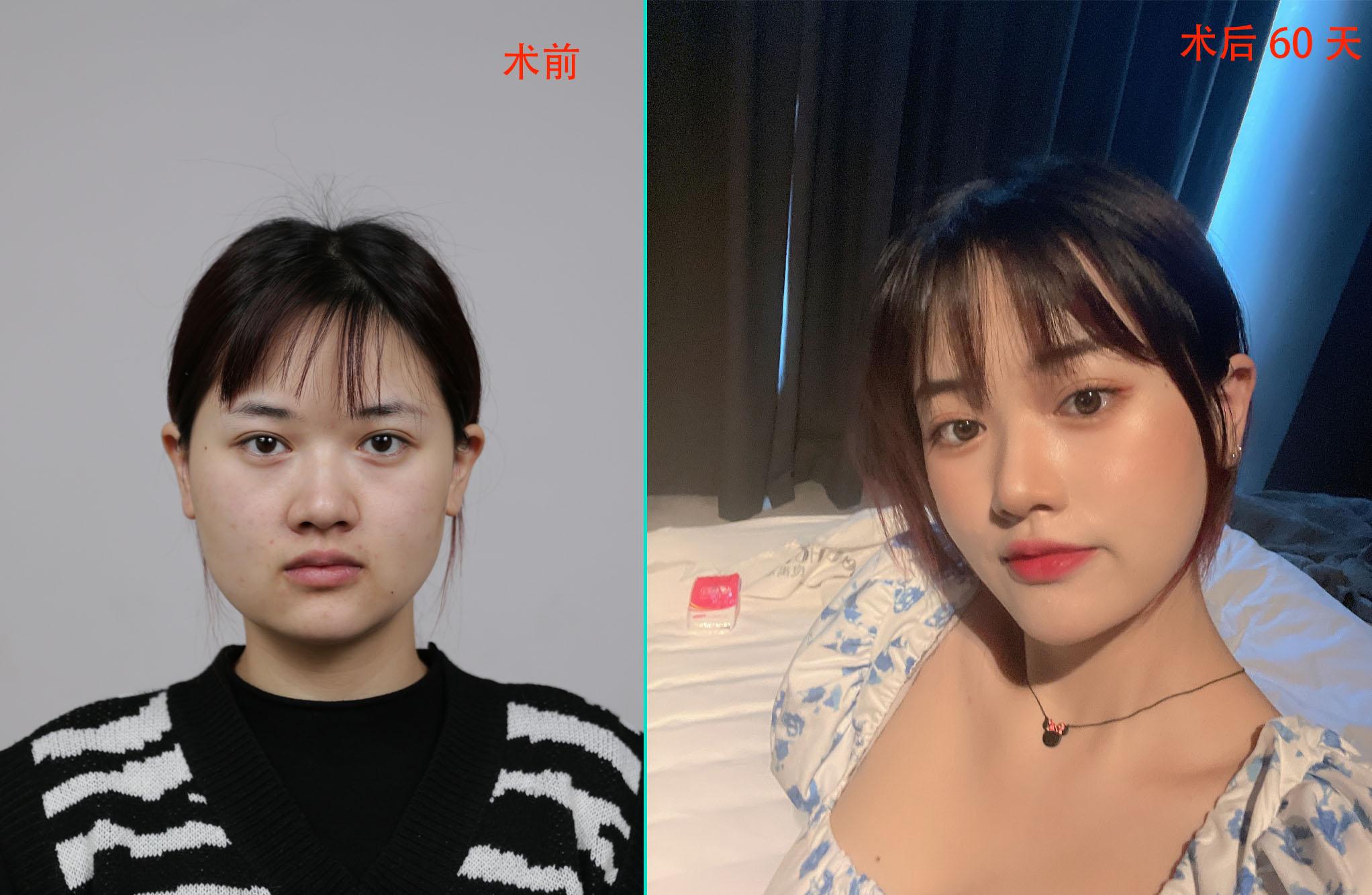 25岁小姐姐做完面部吸脂60天，父母以为我悄悄换了一张脸-面部吸脂后还会再胖回来吗？