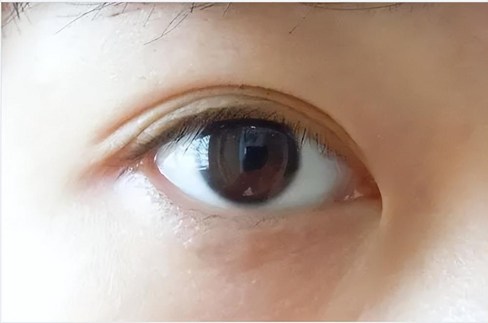 三眼皮如何恢复成双眼皮-变双眼皮多少钱