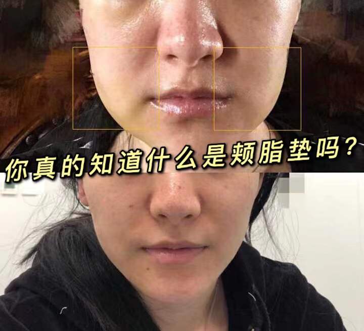 婴儿肥还是嘟嘟肉？口角两侧的肉肉到底是什么？-打瘦脸针嘴角多了两坨肉
