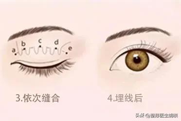 埋线双眼皮3年后眼部怎么样了？大家的表现太真实了！45岁埋线双眼皮还是切双眼皮