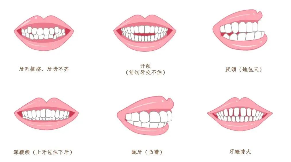做牙齿矫正前，你可能需要了解这些-成人牙齿矫正流程