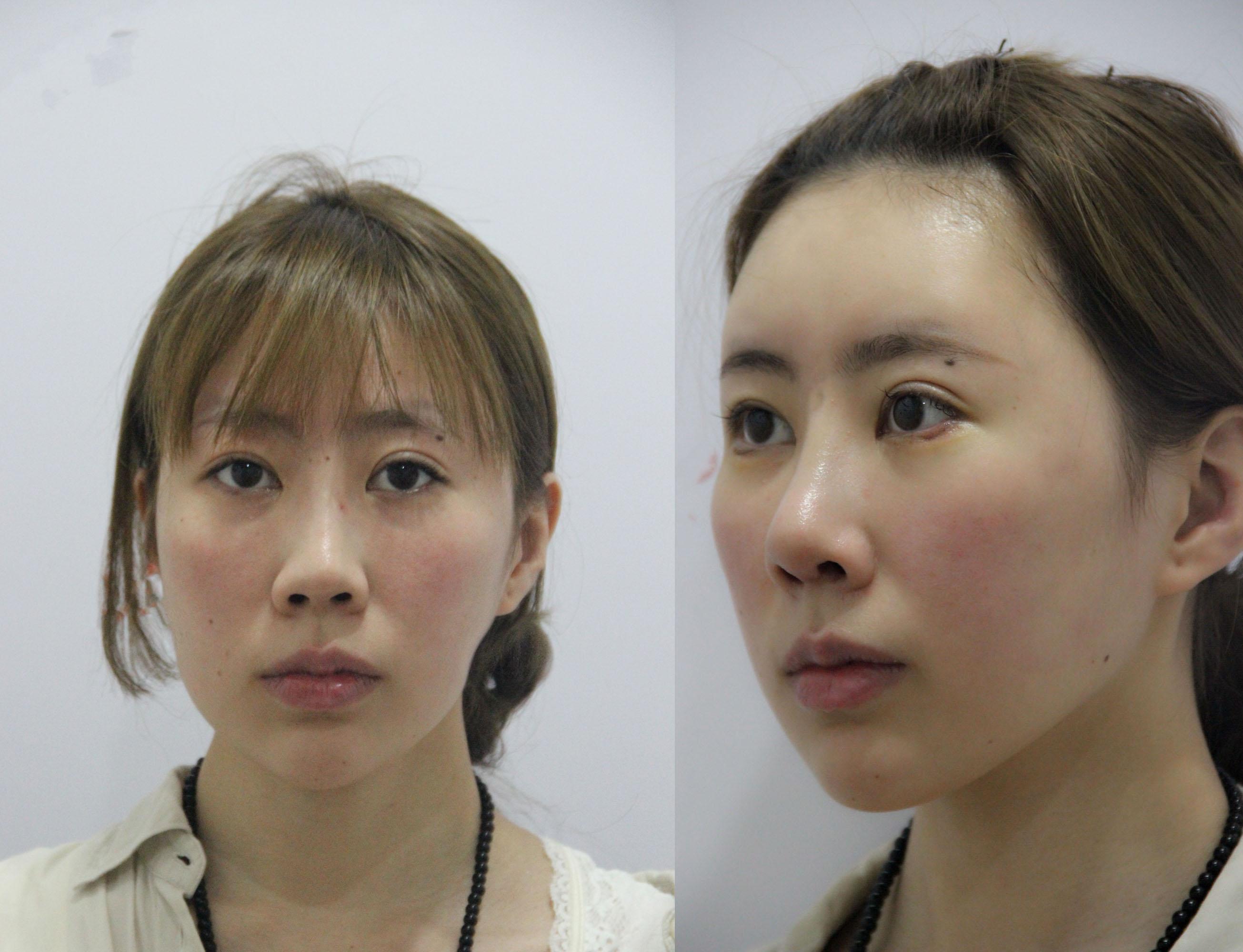 32岁宝妈自体脂肪填充50天，亲戚以为我悄悄地换了一张脸-自体脂肪填充多长时间
