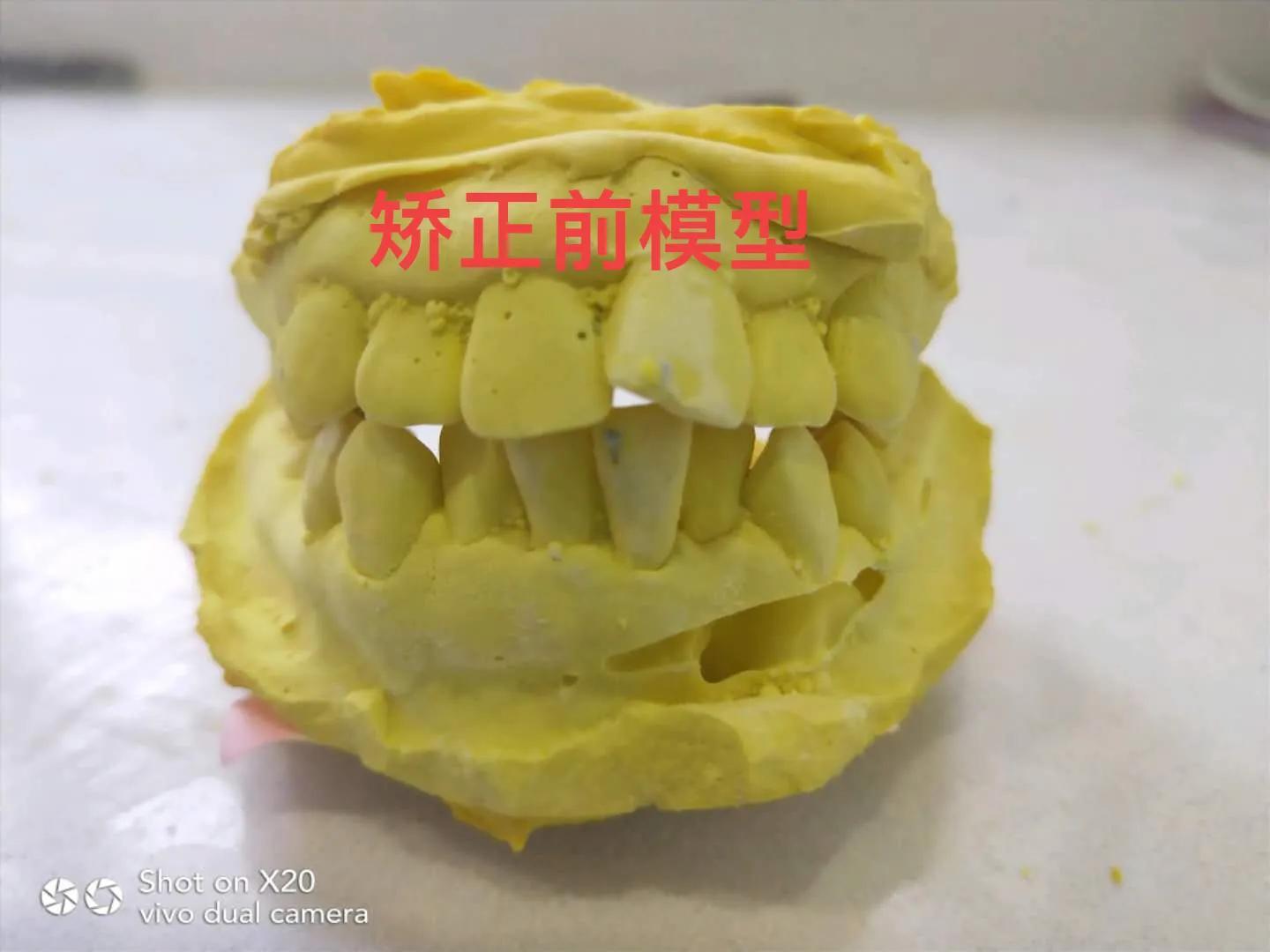 牙齿矫正花费了多少钱呢？矫正前后-矫正牙齿的大概费用多少钱