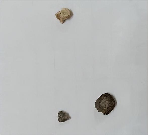 清美一口油条，磕掉73岁老伯一颗牙-断一个牙齿保险公司赔多少钱