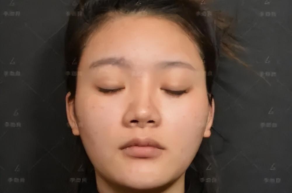 上海00后姑娘，网红医院做L型硅胶隆鼻，1年就顶的鼻尖发白？-硅胶隆鼻感染期是多久