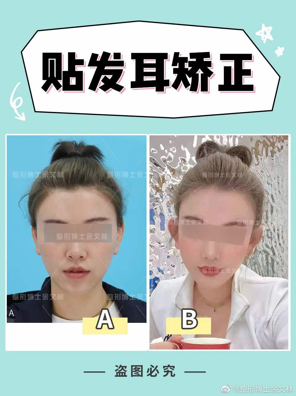 用耳软骨隆鼻后，还可以做贴发耳矫正吗？-鼻综合耳软骨显形