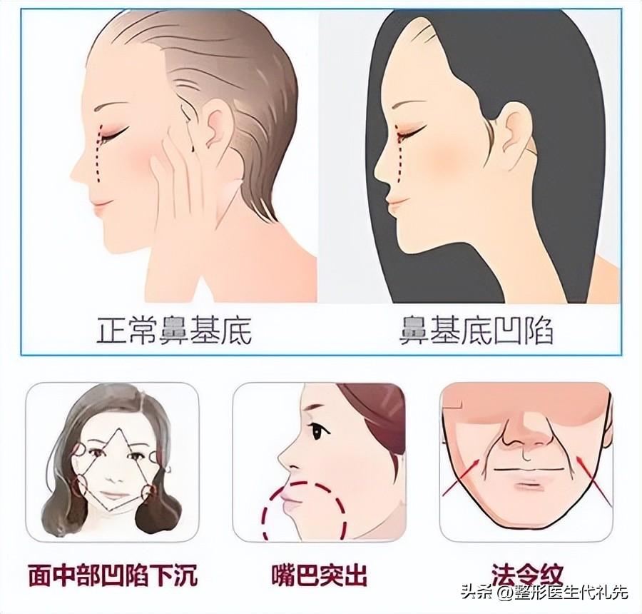 对于鼻基底填充选择什么材料感到纠结？你想知道的都在这里-鼻基底用玻尿酸填充的利弊