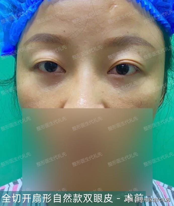 43岁来北京做全切开扇自然款双眼皮，朋友说眼睛看着年轻了10多岁四十岁适合做埋线双眼皮吗