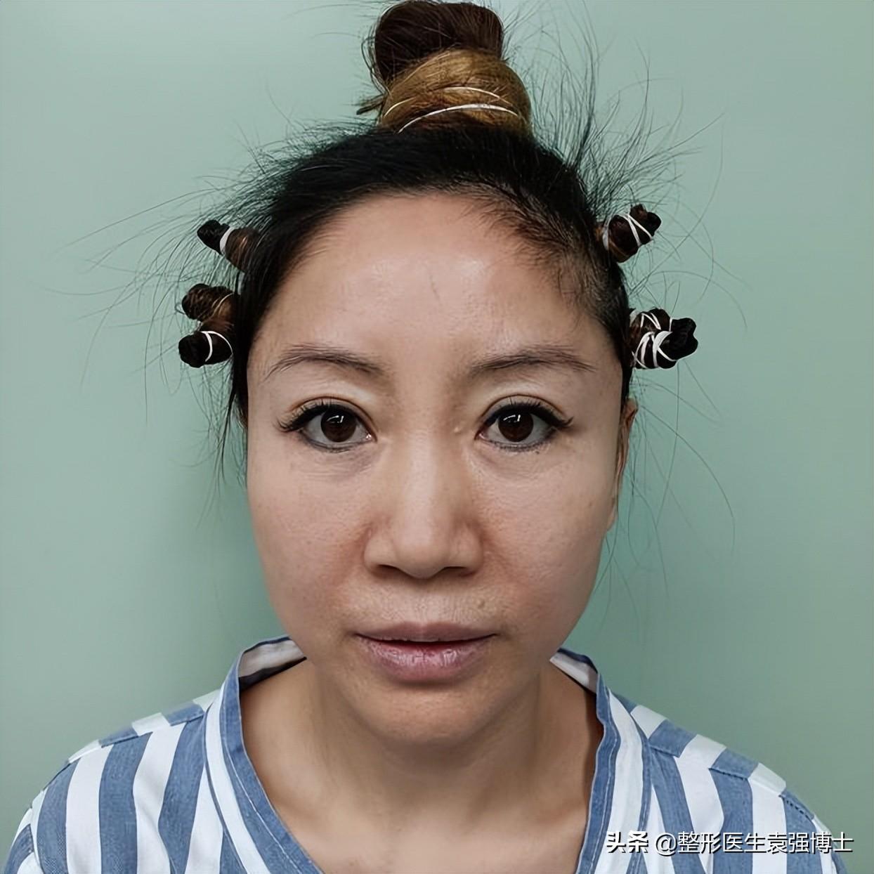45岁从沈阳专门来北京做拉皮，3个月效果大分享，前后像“两人”