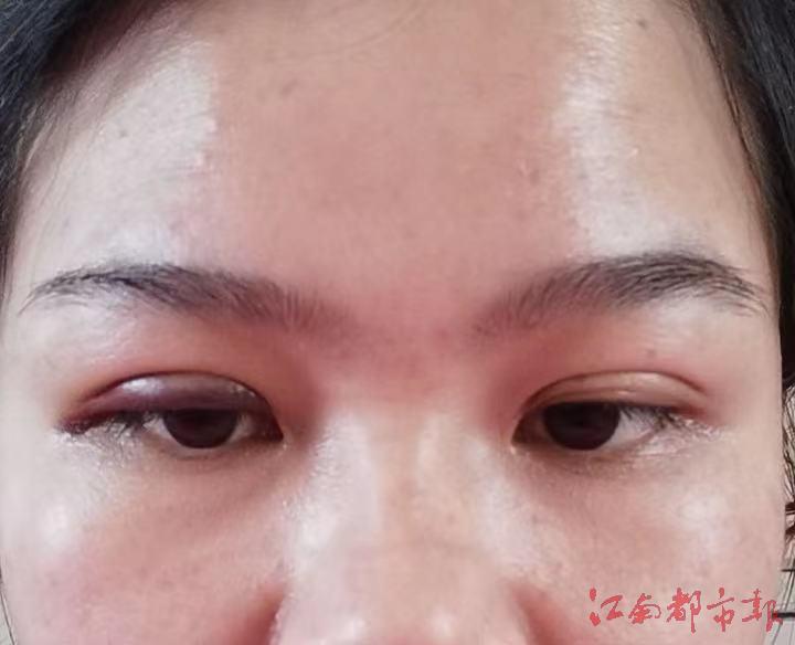 赣州信丰大塘筱菲御美业被投诉！不开刀免麻的双眼皮能做吗