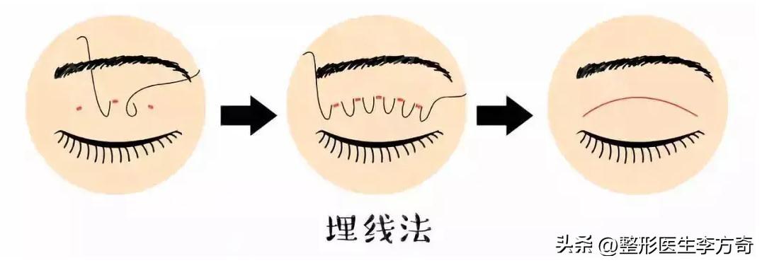 双眼皮有几种术式？埋线、三点小切口、全切，你适合哪种？-全切双眼皮和埋线双眼皮效果图