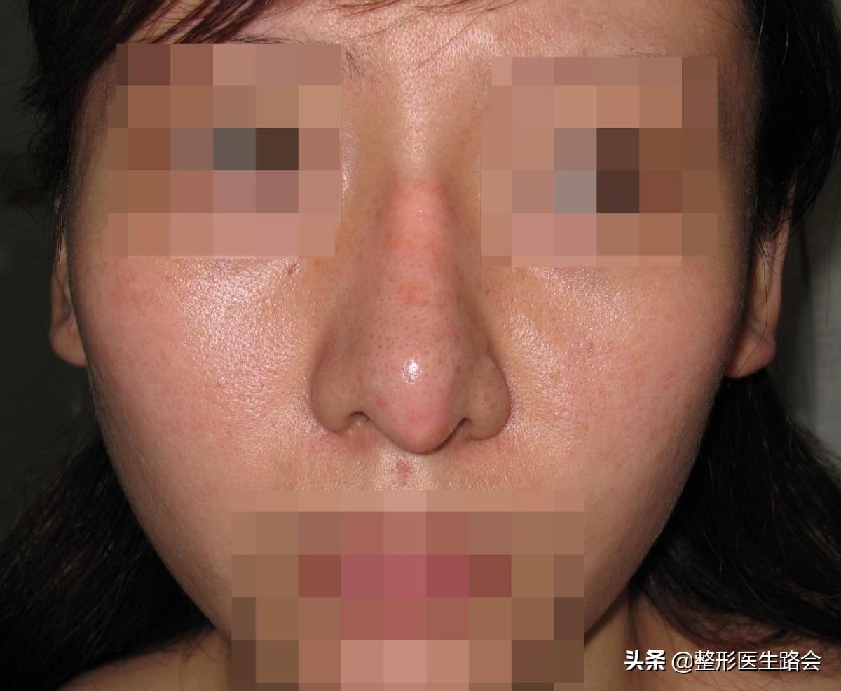 25岁“硅胶隆鼻”歪斜、穿出！修复3个月，说几句大家不知道的-鼻子硅胶隆鼻宽肿