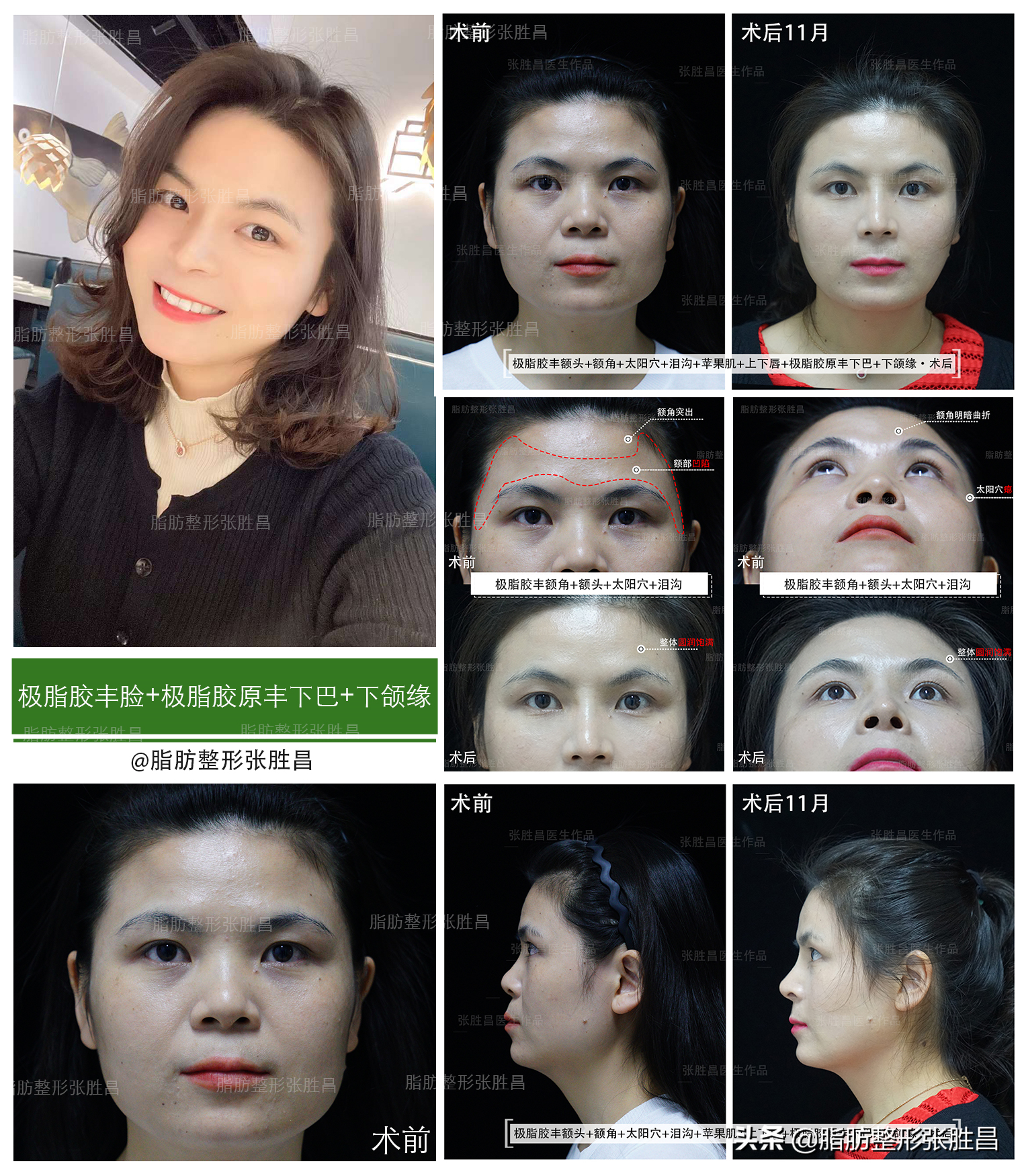 作为做过“脂肪填充”的过来人，告诉你们5个真相-什么是脂肪填充手术