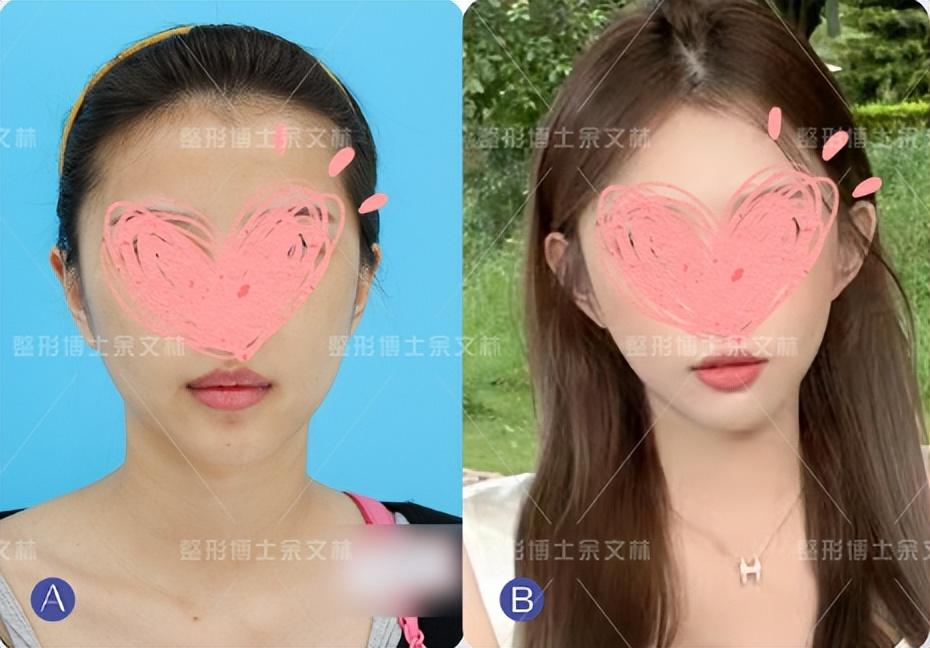 贴发耳矫正手术一般要做多久？这些手术关键需了解！-矫正牙齿手术费用多少钱
