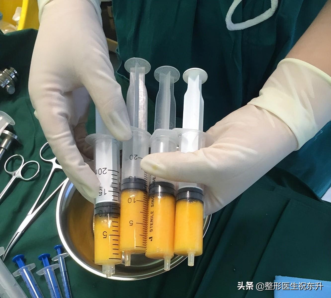 医生不会说做脂肪填充，取哪里的脂肪长得好？多久算成活？-哪个脂肪填充好点