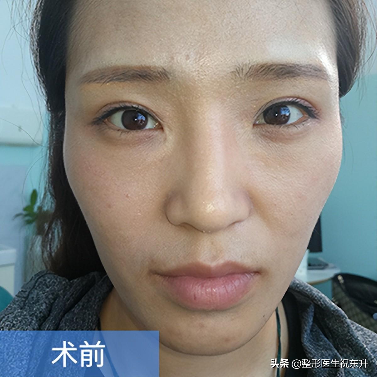 第一次做自体脂肪填充全脸，发几张照片，医生和护士都“酸”了-自体脂肪填充恢复期真的是个难熬的时期