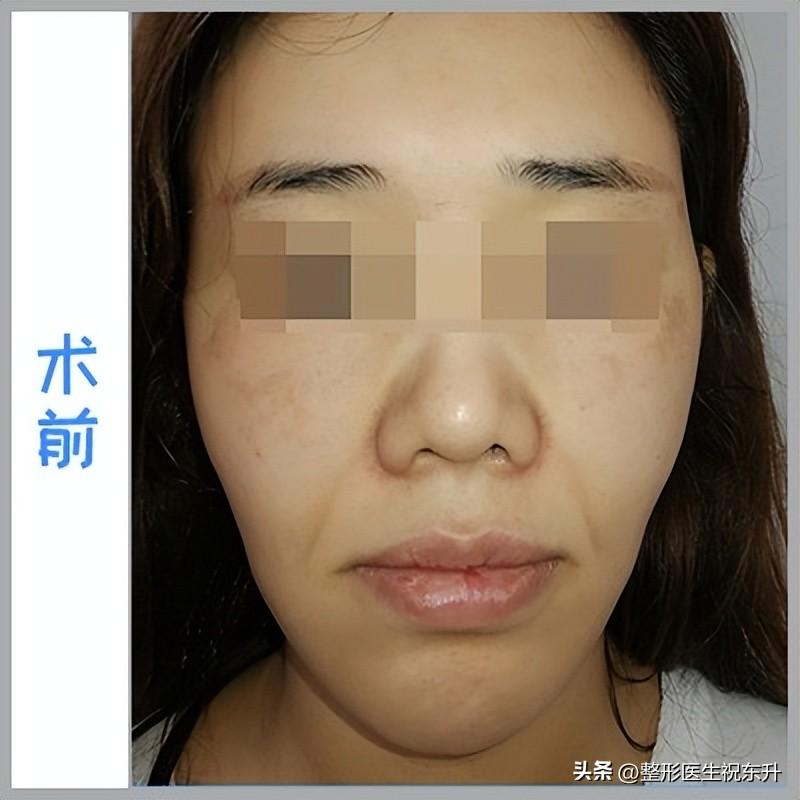 拖了大半年，终于把拉皮手术做了！几张照片真实记录5个月的变化-产后做吸脂会皮松吗