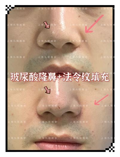 玻尿酸隆鼻的好处打玻尿酸可以隆鼻子吗