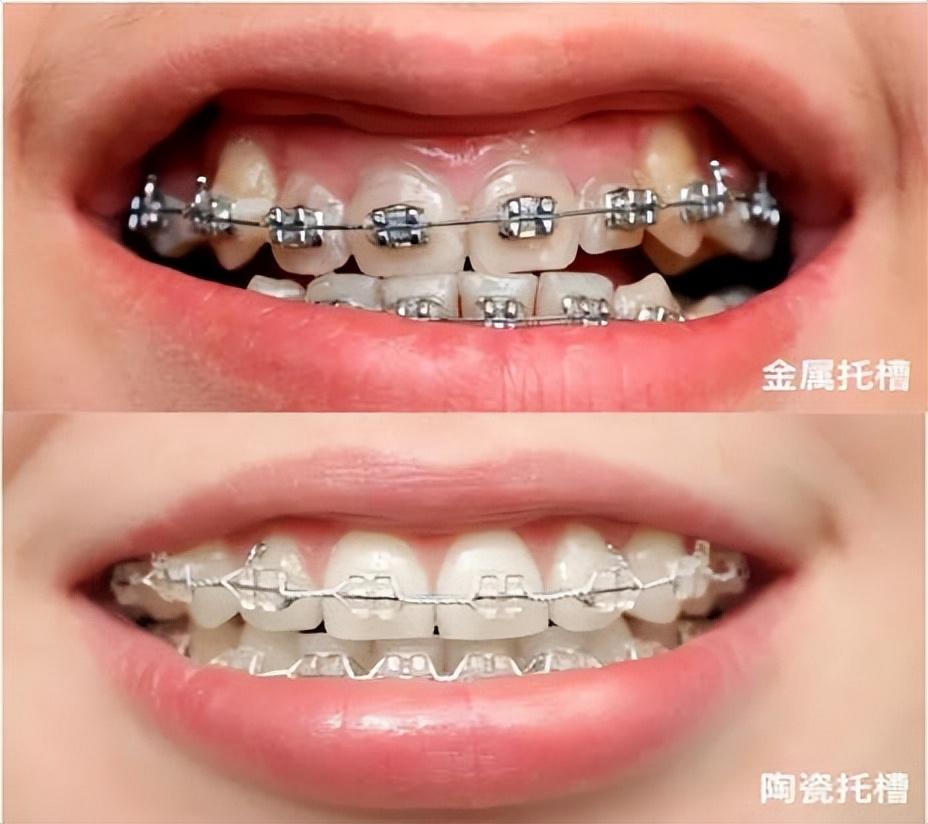 牙齿矫正，这些事儿先问清楚牙齿局部矫正价格