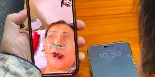 62岁上海阿姨为穿旗袍，抽脂感染住进ICU！6次手术花费上百万，现依然躺在医院哪里医院吸脂瘦身好