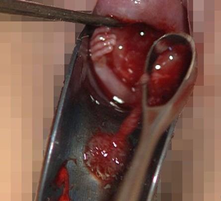 怎样折腾才能自然流产，怀孕了怎么才能自然流产（人工流产采用哪种方法比较好）