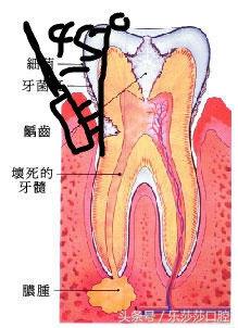 蛀牙会自愈么，蛀牙能治愈吗（蛀牙会传染吗）