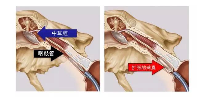 耳朵进水出不来怎么办，水进入耳朵了出不来怎么办（耳朵深处“进水”，蹦不出来）