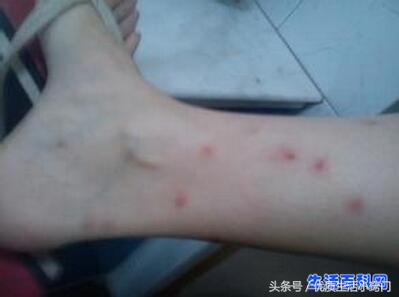 被跳蚤咬的症状图片，跳蚤咬的症状是什么（跳蚤咬人的症状）