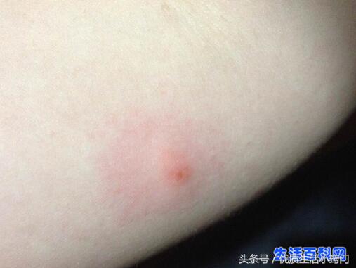被跳蚤咬的症状图片，跳蚤咬的症状是什么（跳蚤咬人的症状）