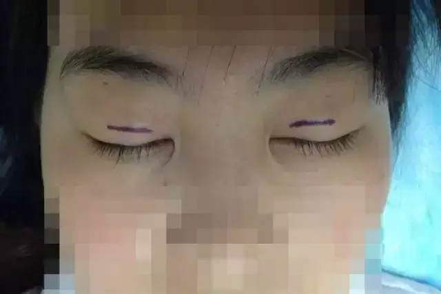 韩式纳米无痕双眼皮，纳米无痕双眼皮是什么（韩式三点五点、芭比翘睫、这些神乎其神的双眼皮技术有多厉害）