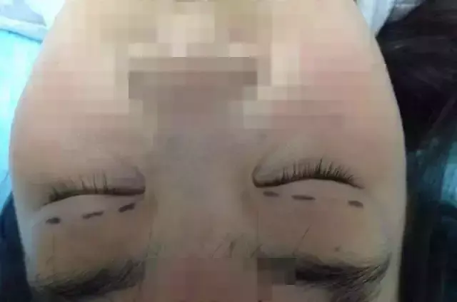 韩式纳米无痕双眼皮，纳米无痕双眼皮是什么（韩式三点五点、芭比翘睫、这些神乎其神的双眼皮技术有多厉害）