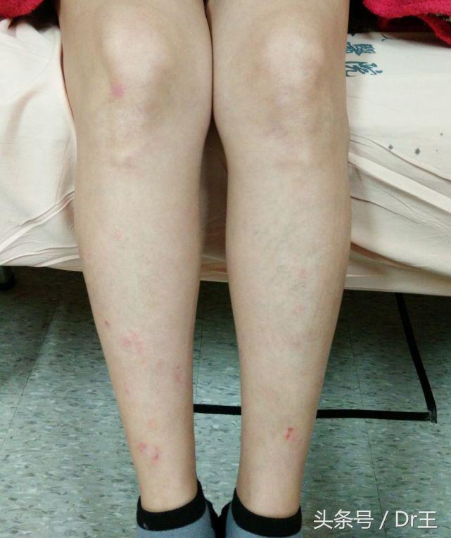 干癣成因有内与外之分，干癣是怎么形成的（干癣抓到破皮，原是免疫疾病）