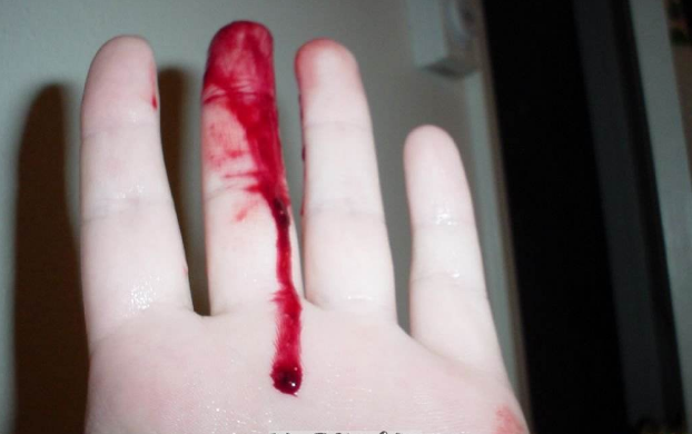 梦见手指受伤什么意思，梦见手指受伤了的预兆（梦见自己身上流血）