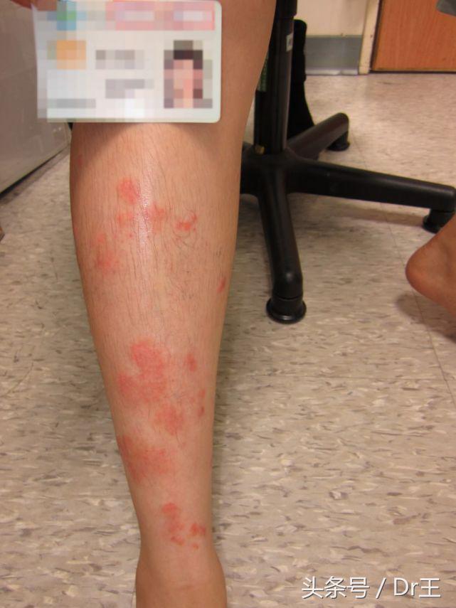 干癣成因有内与外之分，干癣是怎么形成的（干癣抓到破皮，原是免疫疾病）