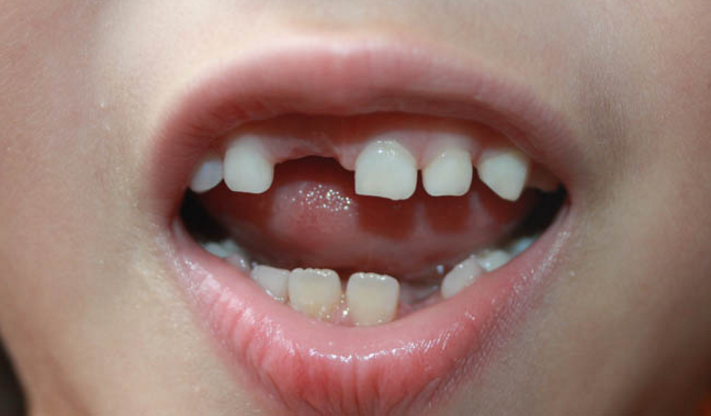 做梦掉牙预示着什么，做梦掉牙是因为什么（梦见自己掉牙齿了）