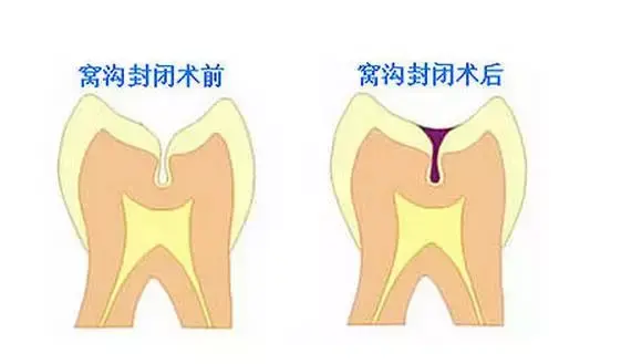 做窝沟封闭把孩子坑了，孩子做窝沟封闭有必要吗（小心孩子恨你一辈子）