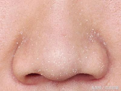 什么是白头粉刺,满脸白头粉刺(最招年轻人恨的面部问题)