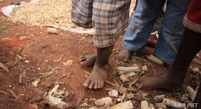 挖出脚趾上的大沙蚤，非洲恐怖的“寄生恶魔”（这个国家穷的连鞋子都穿不起）