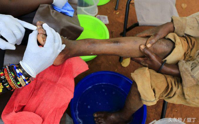 挖出脚趾上的大沙蚤，非洲恐怖的“寄生恶魔”（这个国家穷的连鞋子都穿不起）