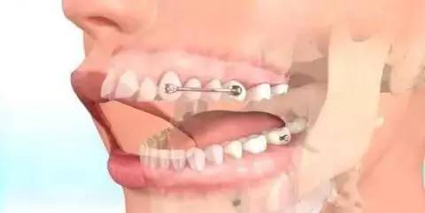 怎么样改变脸型，如何改变脸型（一步一步细节告诉你牙齿矫正是如何改变脸型的）