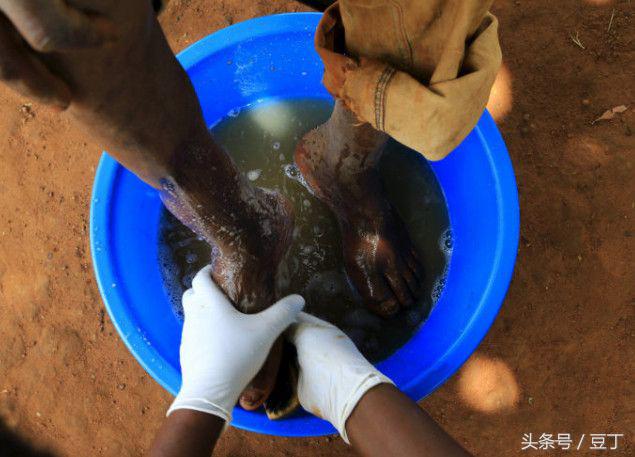 挖出脚趾上的大沙蚤，非洲恐怖的“寄生恶魔”（这个国家穷的连鞋子都穿不起）
