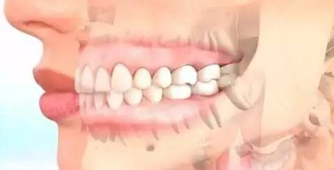 怎么样改变脸型，如何改变脸型（一步一步细节告诉你牙齿矫正是如何改变脸型的）