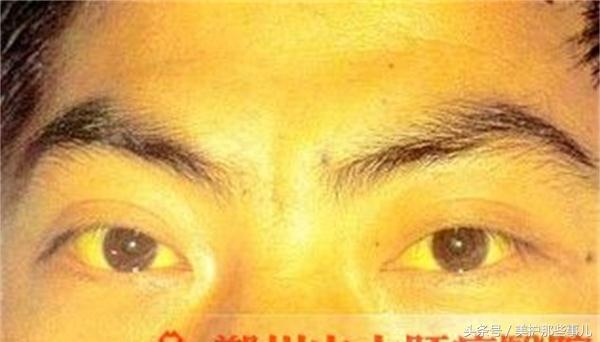 茵陈和什么泡水喝对肝脏最好，怎样用茵陈泡水喝（清热利胆、保肝、降压降脂、治黄斑）