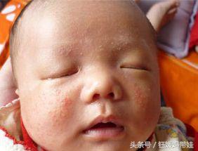 婴儿湿疹是热出来的吗，婴儿干性湿疹是因为热的吗（只要细心护理就可轻松搞定湿疹）