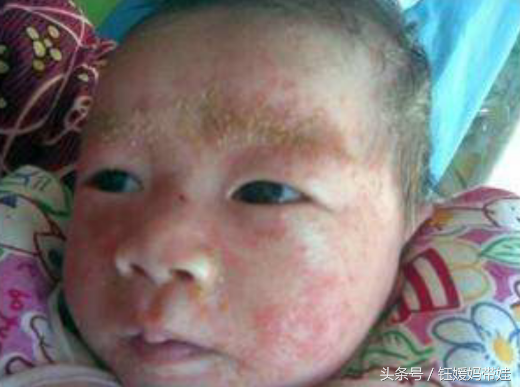 婴儿湿疹是热出来的吗，婴儿干性湿疹是因为热的吗（只要细心护理就可轻松搞定湿疹）