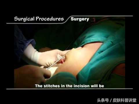 女生去狐臭的方法，女生去除狐臭办法（腋臭的治疗方法汇总）