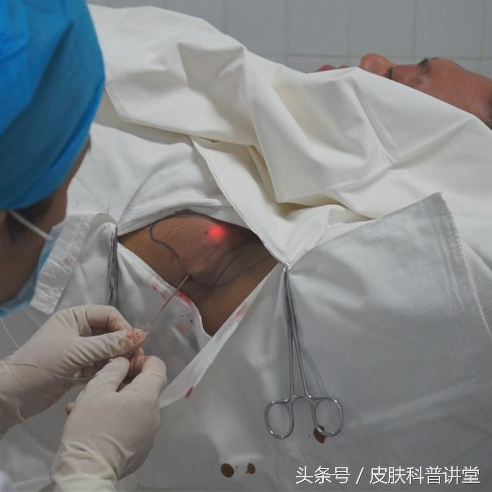女生去狐臭的方法，女生去除狐臭办法（腋臭的治疗方法汇总）