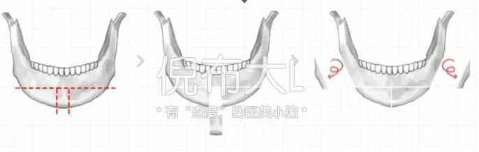 垫下巴是怎么回事，垫下巴的坏处（娱乐圈女星都选择了哪几种垫下巴方法）