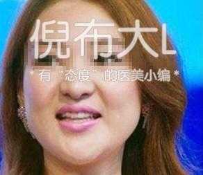 垫下巴是怎么回事，垫下巴的坏处（娱乐圈女星都选择了哪几种垫下巴方法）