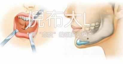 垫下巴是怎么回事，垫下巴的坏处（娱乐圈女星都选择了哪几种垫下巴方法）